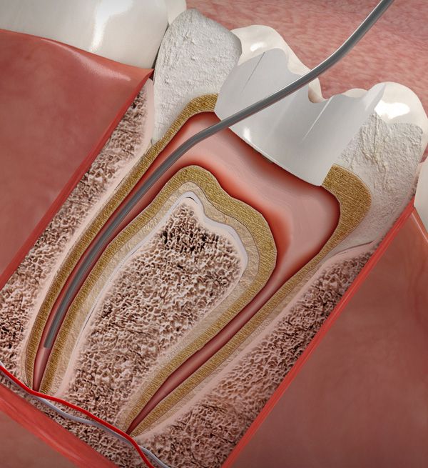 Wurzelkanalbehandlung